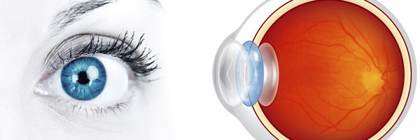 Clear lens procedure illustration